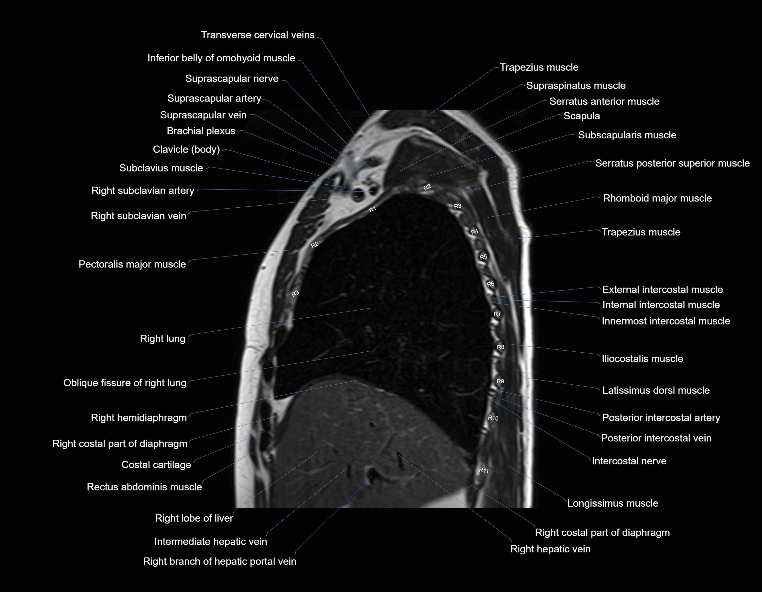 MRI chest (thorax) sagittal labelled cross sectional anatomy 3T radiology image-img-00001-00012.webp